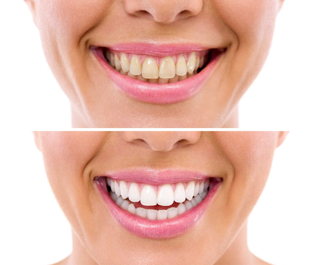 blanqueamiento dental en Coslada