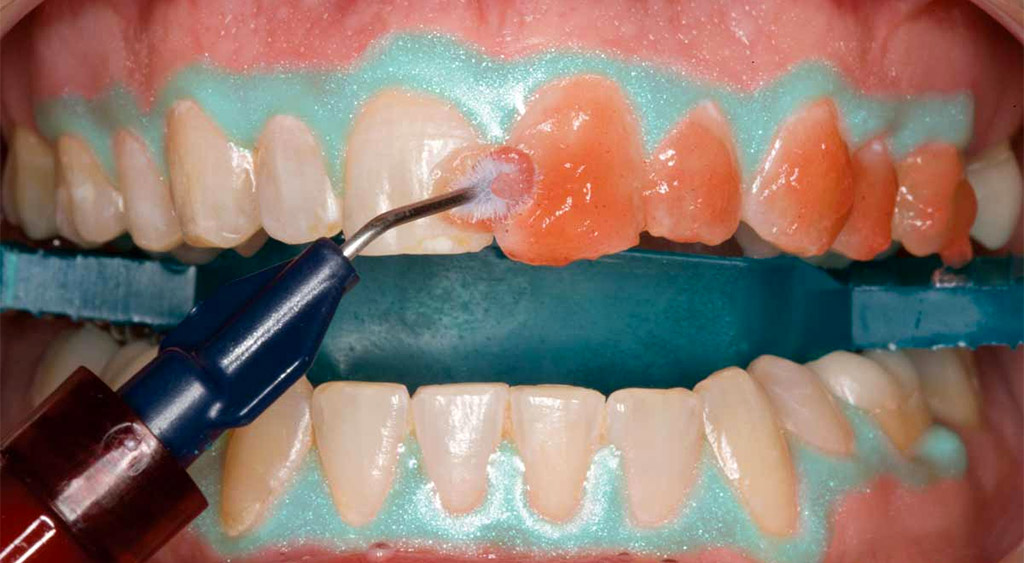 blanqueamiento dental en Coslada