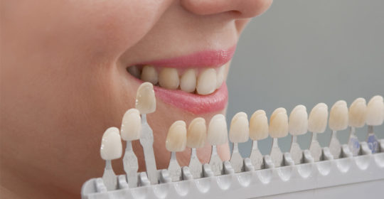 Preguntas frecuentes sobre blanqueamiento dental en Coslada