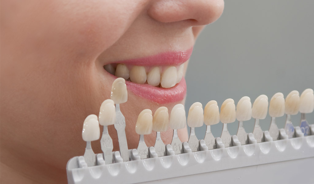 blanqueamiento dental en Coslada