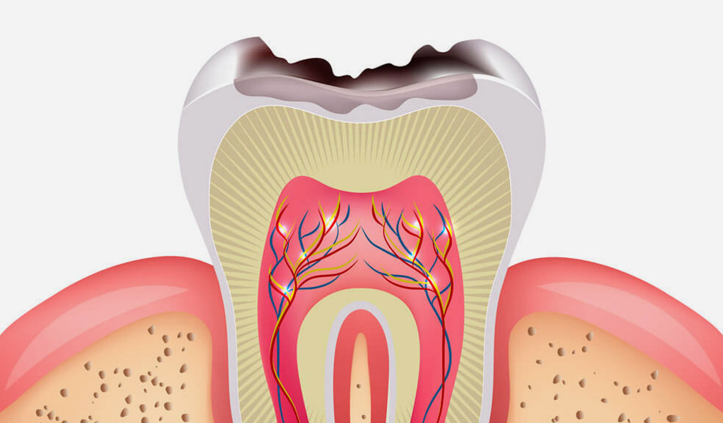 Prevención de caries en Coslada