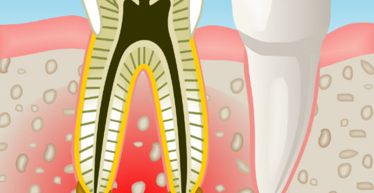 Especialistas en endodoncia en Coslada