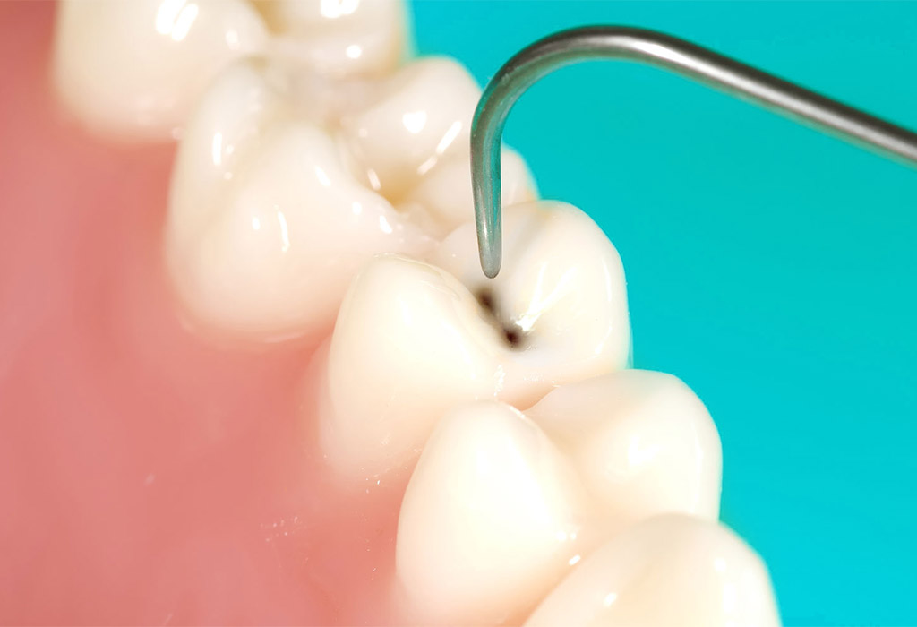 endodoncia en Coslada