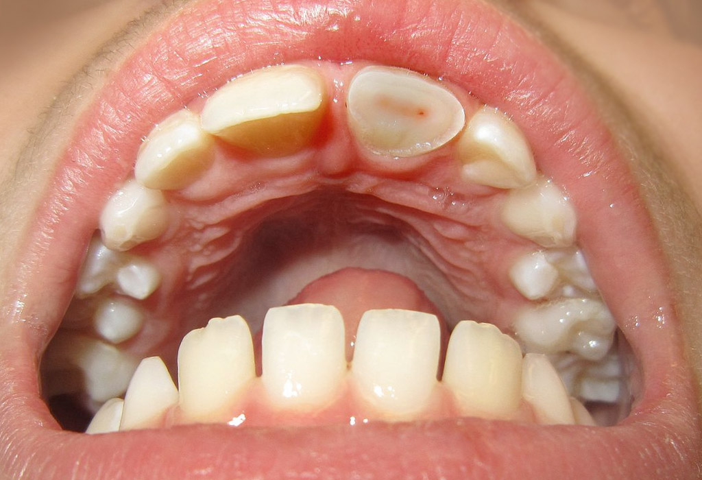 endodoncia en Coslada