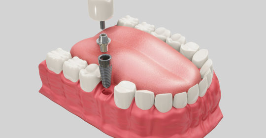Implantes dentales de carga inmediata en Coslada en una clínica dental segura