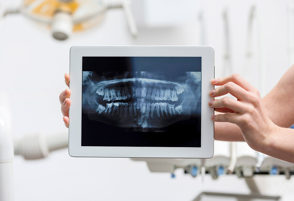 Implantes dentales de carga inmediata en Coslada