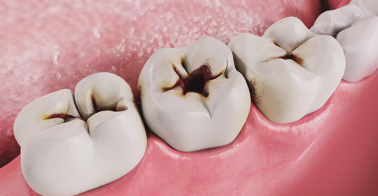 Prevención de caries en Coslada